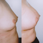 implanty piersi