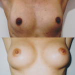 powiększenie małych piersi implantami