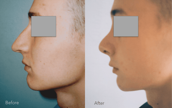 Chirurgia plastyczna twarzy – operacja nosa