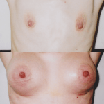 chirurgiczne powiększenie małych piersi implantami