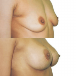 powiekszenie piersi chirurg plastyk Zoń